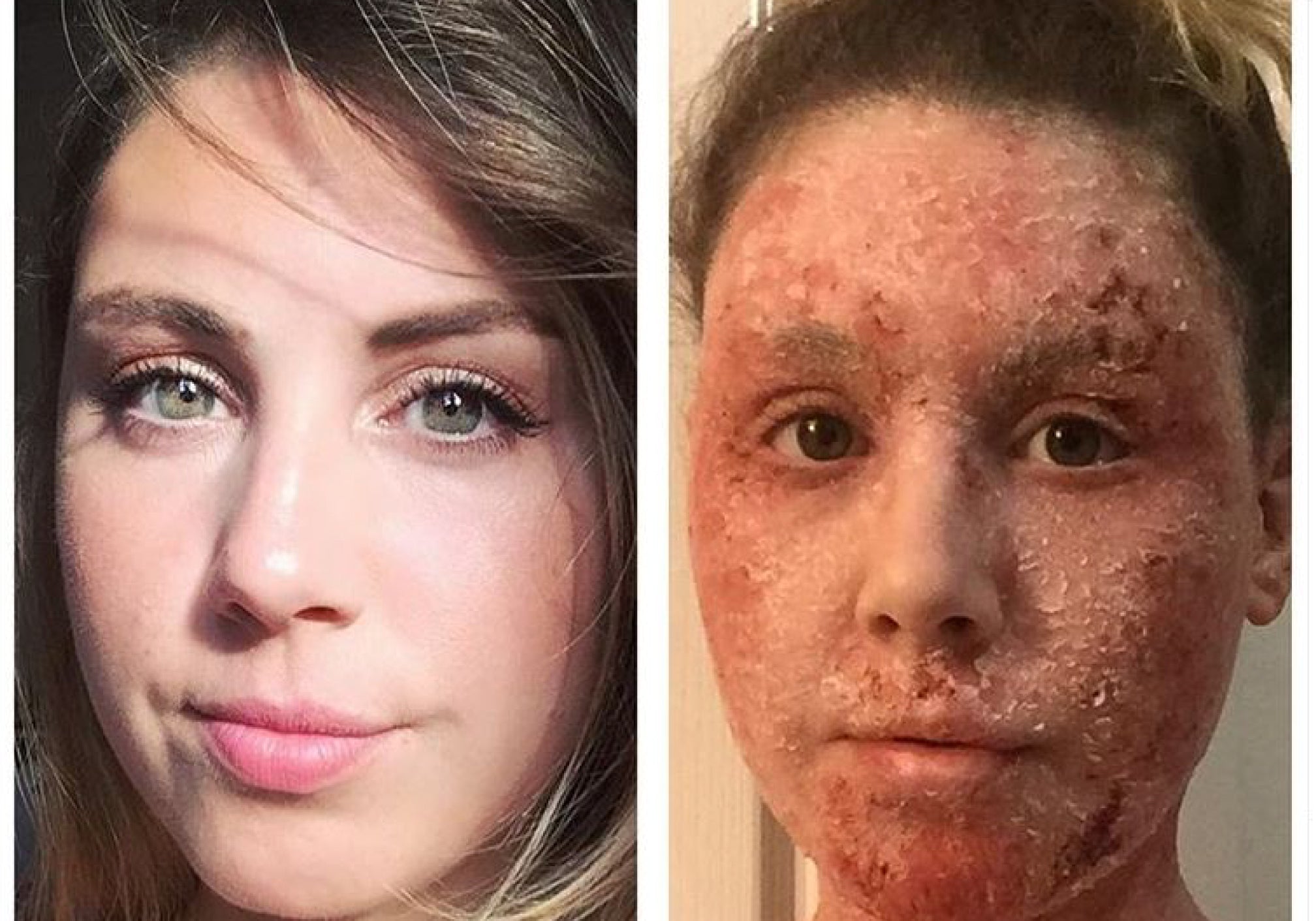 Topical Steroid Withdrawl (TSW): My '(Un)natural Healing' Story