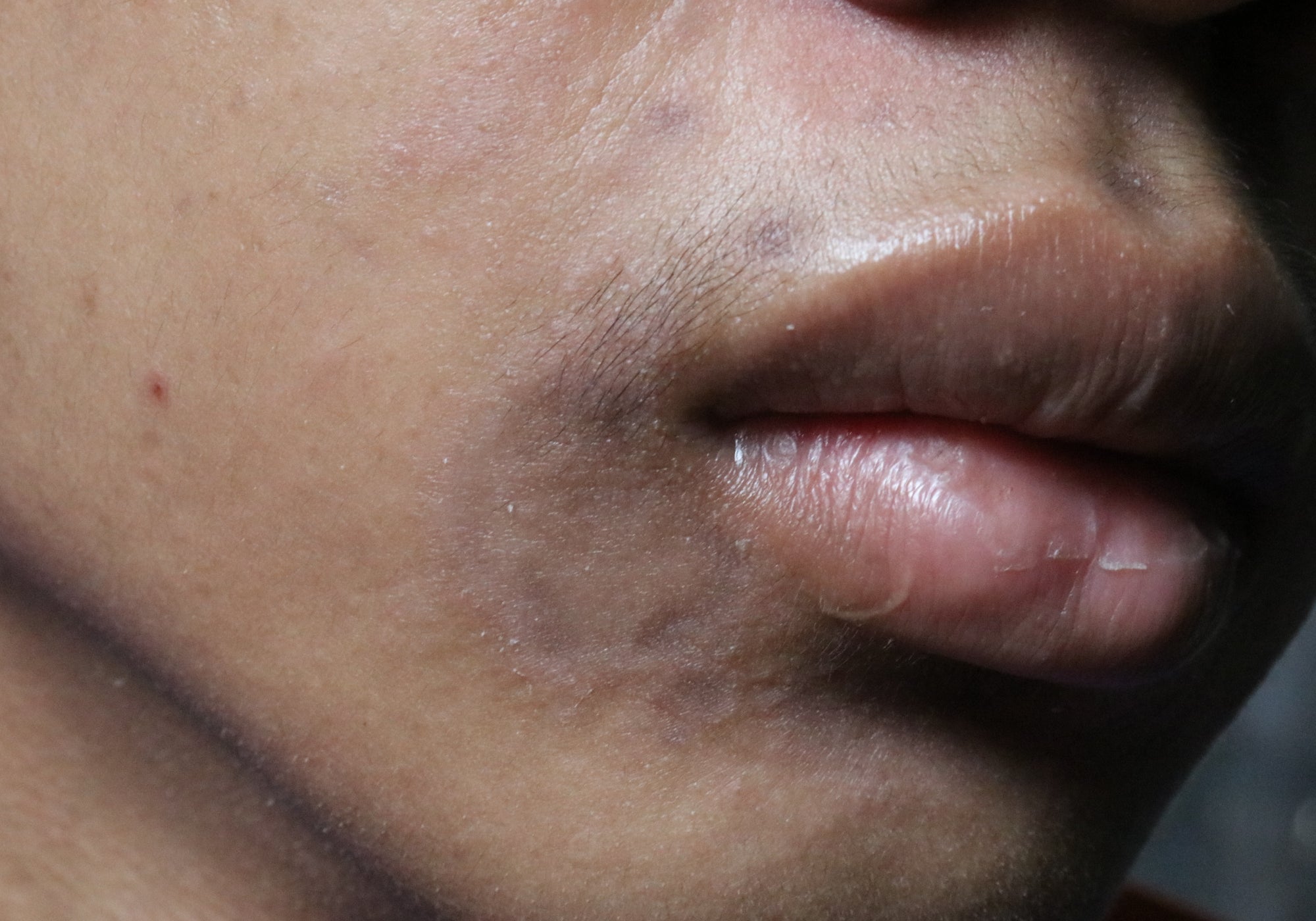 Is Post-Inflammatory Hyperpigmentation Dangerous?