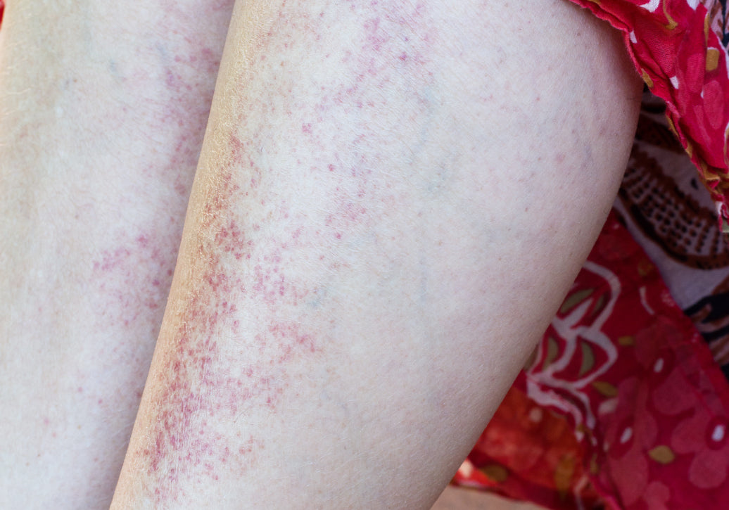 An example of Polymorphic Light Eruption 