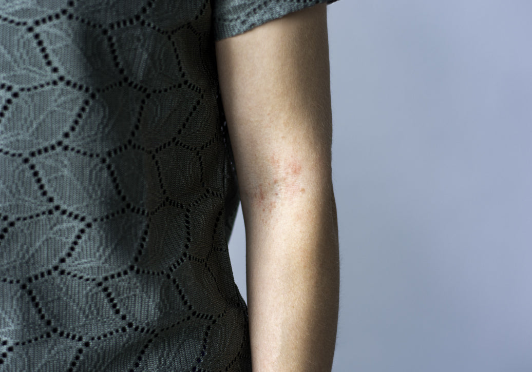 Polymorphic Light Eruption on arm