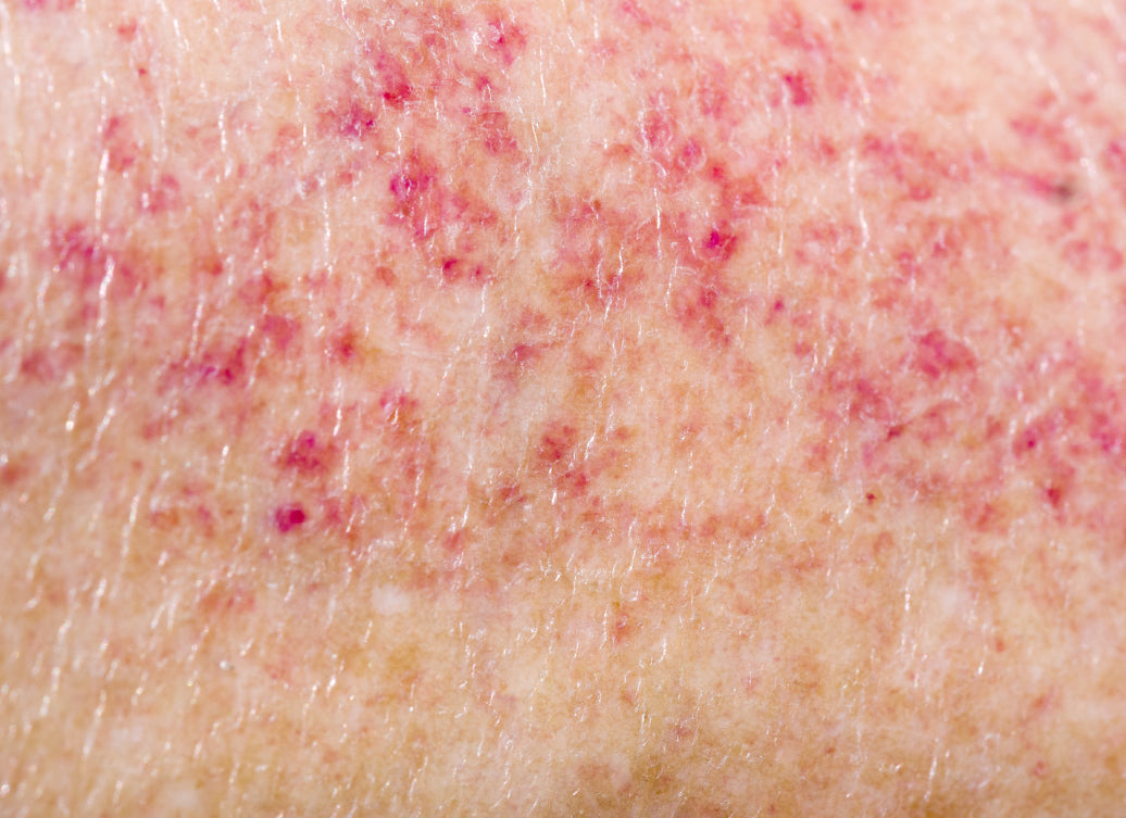 Close up of polymorphic light eruption on the skin