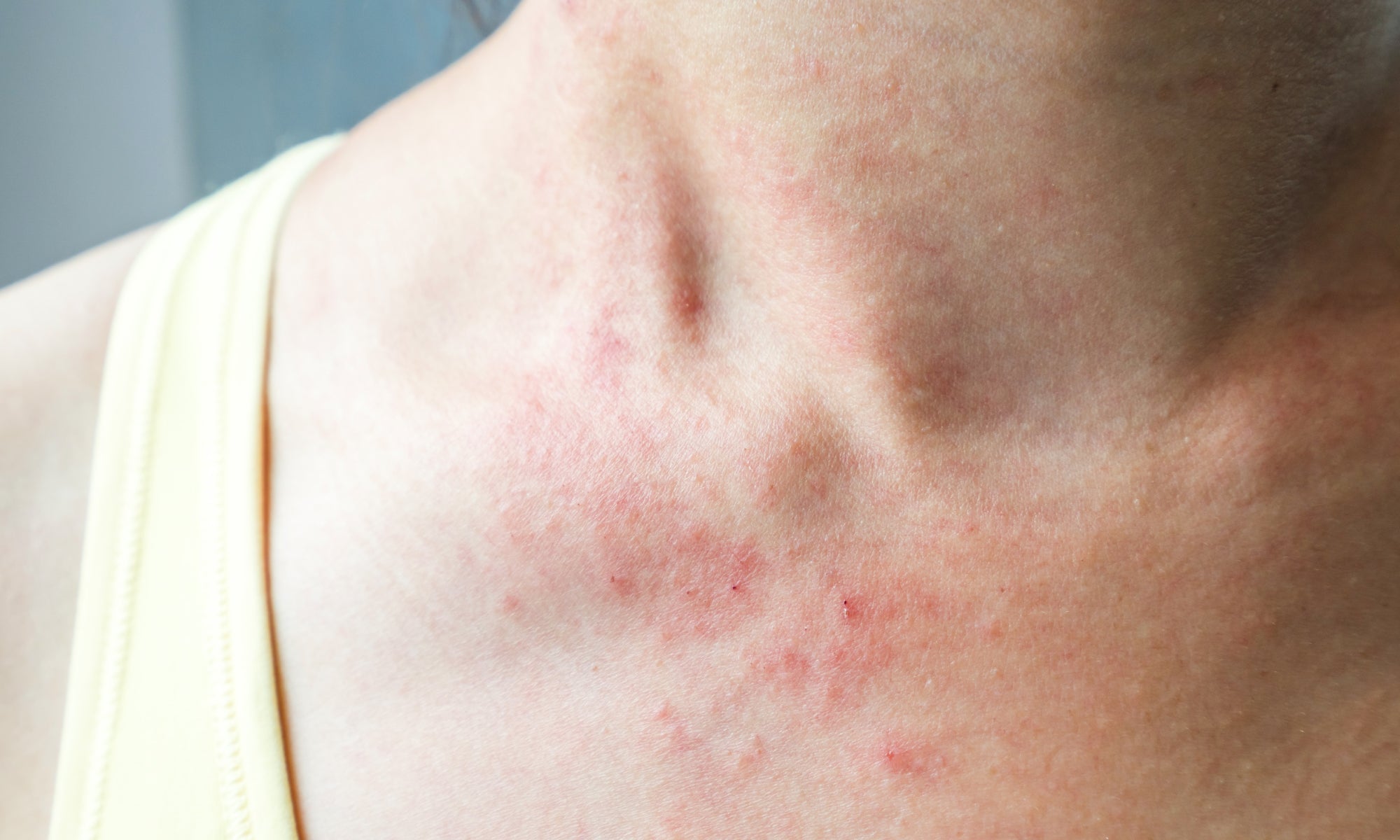 What Can You Put On Chemo Rash?