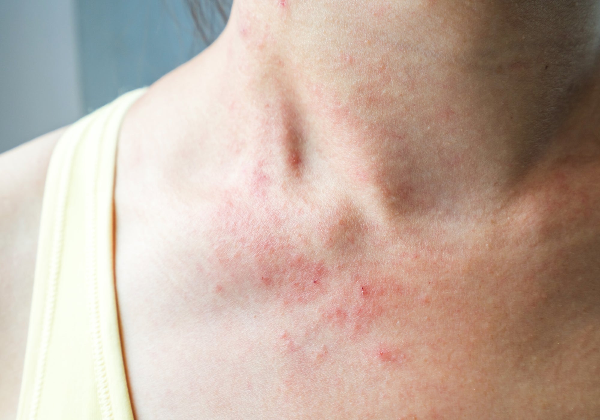 What Can You Put On Chemo Rash?