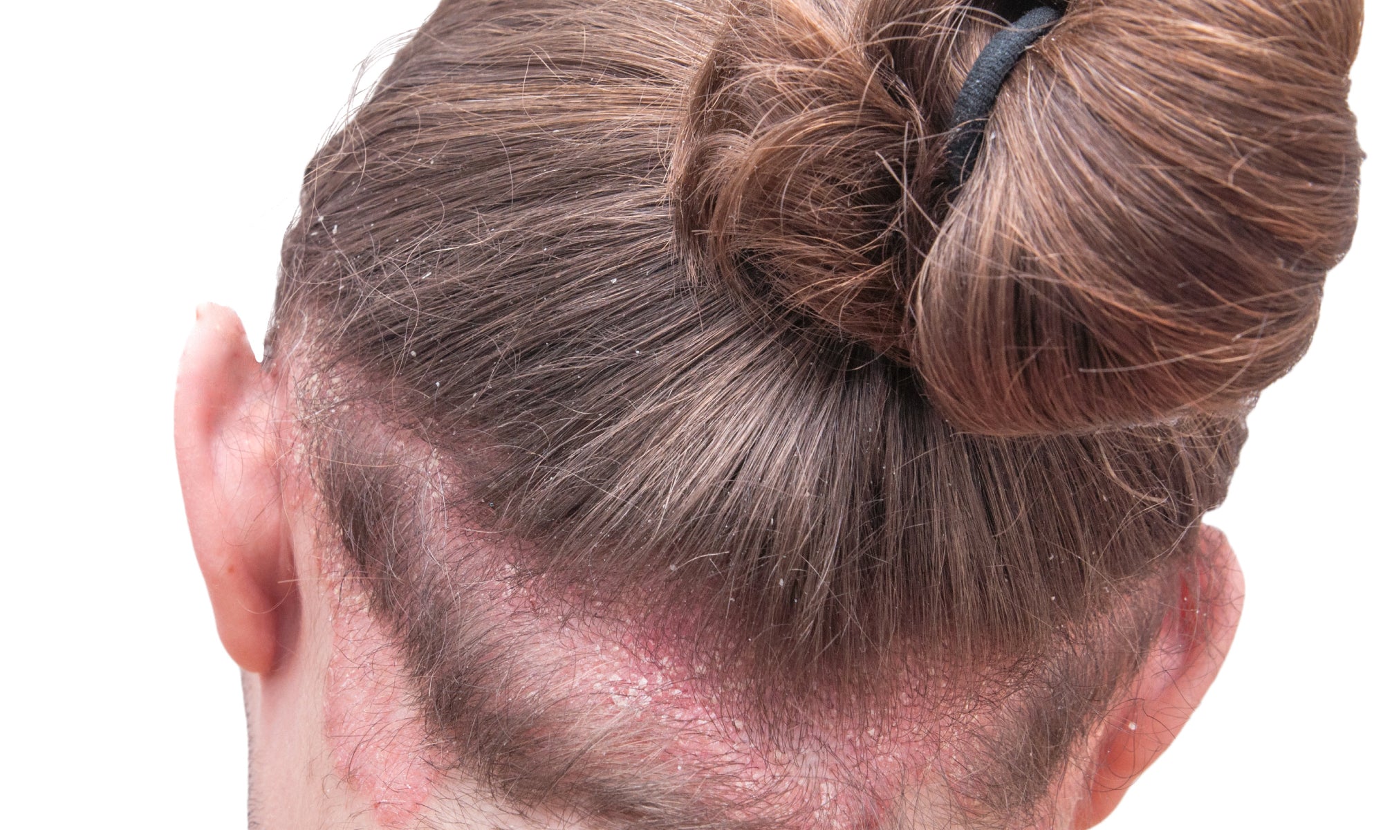 How To Soothe Scalp Psoriasis Naturally