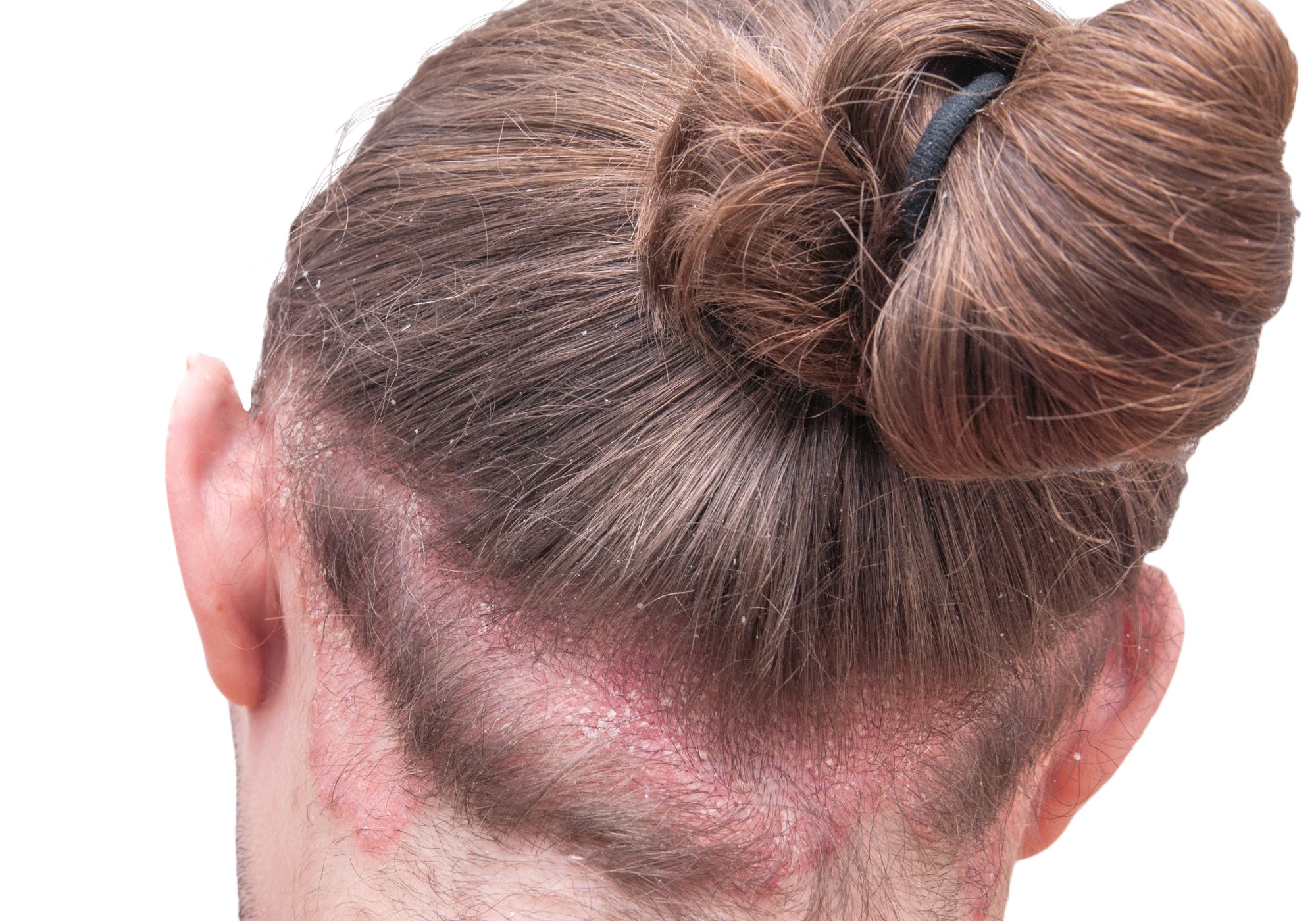 How To Soothe Scalp Psoriasis Naturally