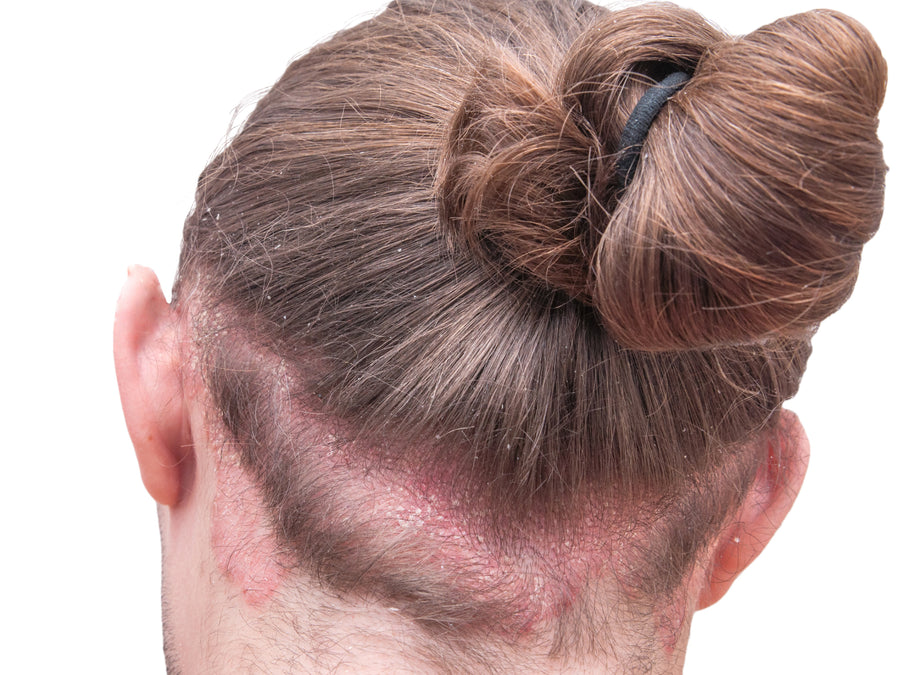 How To Soothe Scalp Psoriasis Naturally