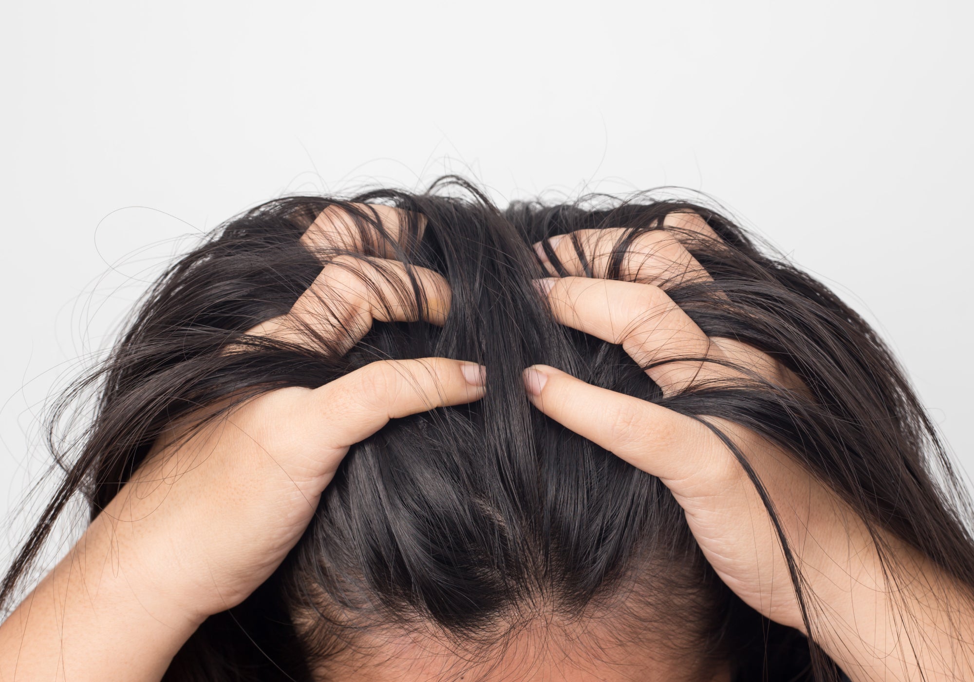 Top 5 Triggers Of Scalp Psoriasis 