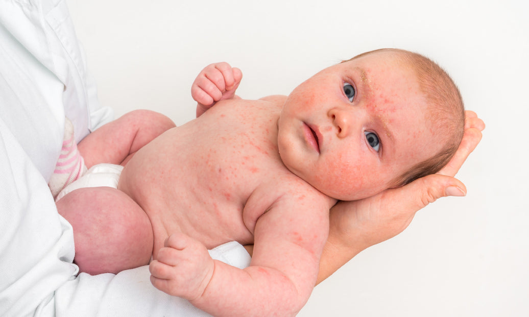 a baby with eczema