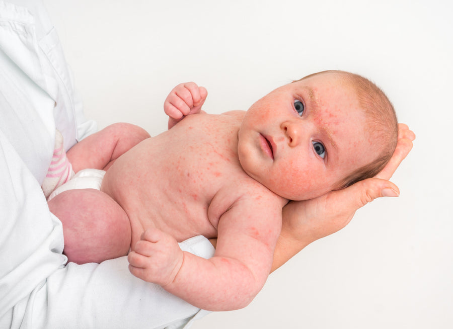 a baby with eczema