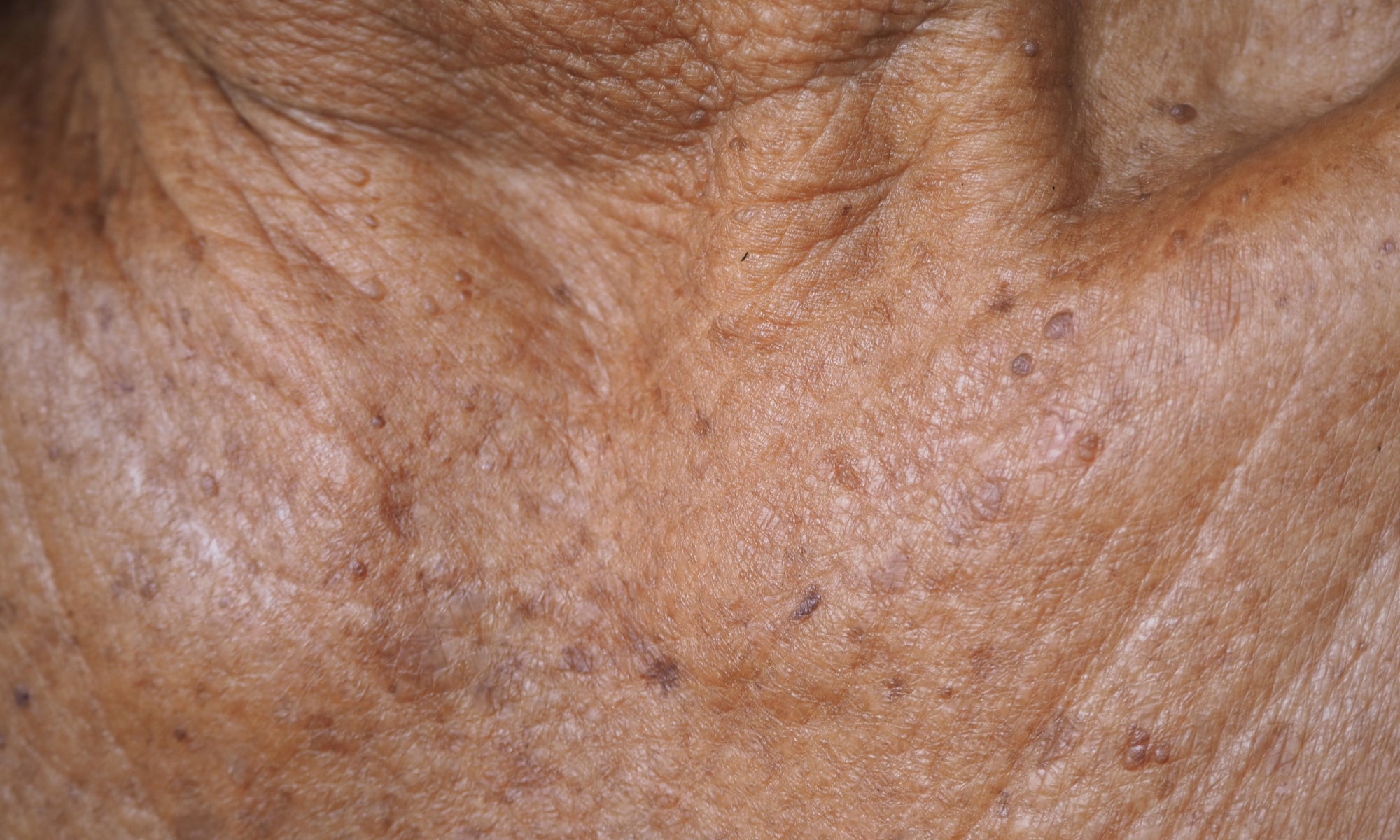 Example of Actinic Keratosis around the neck 