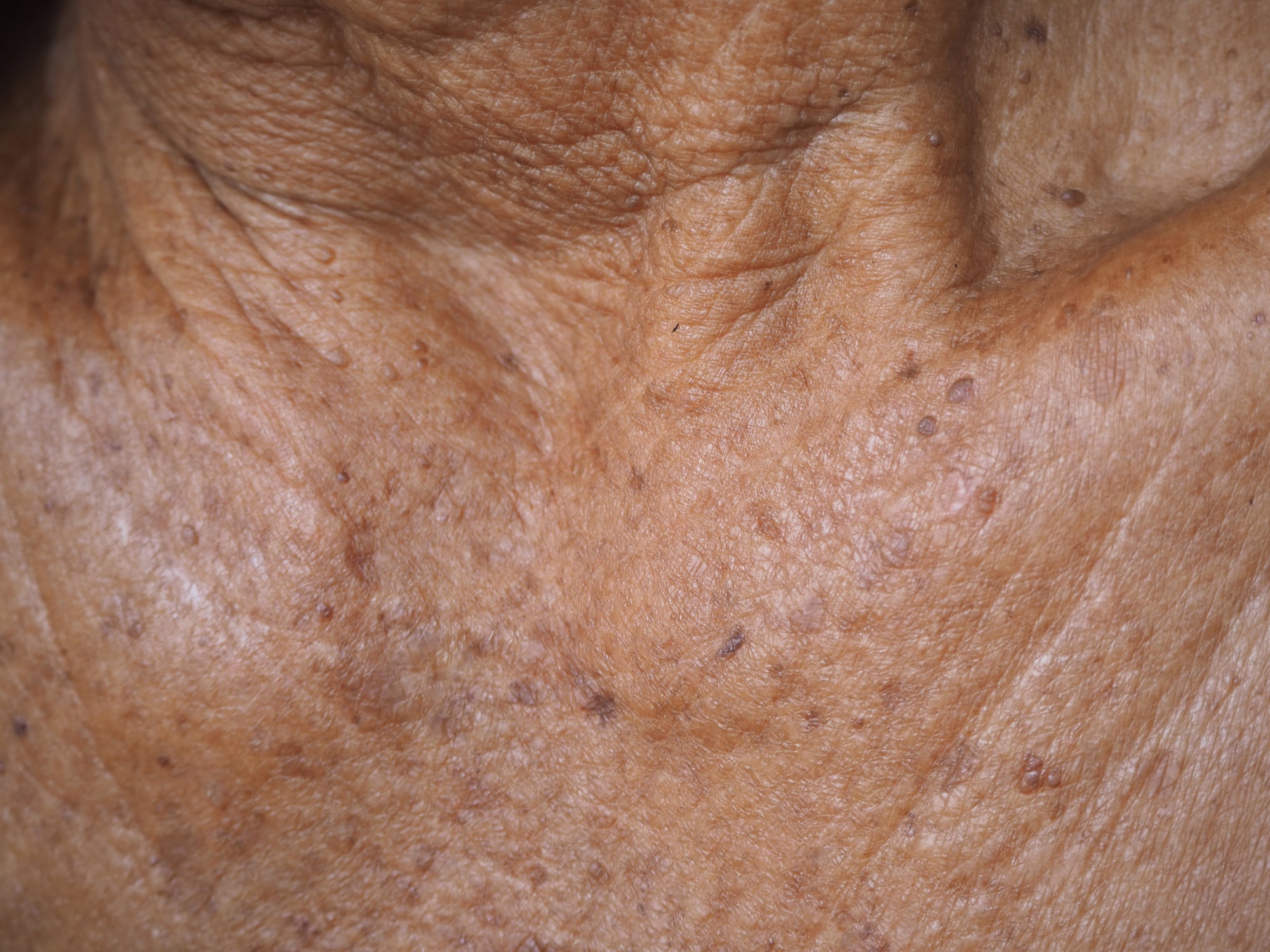 Example of Actinic Keratosis around the neck 