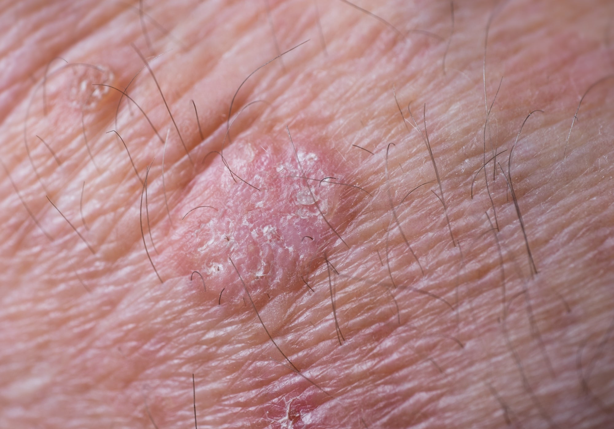 an example of keratosis on the skin