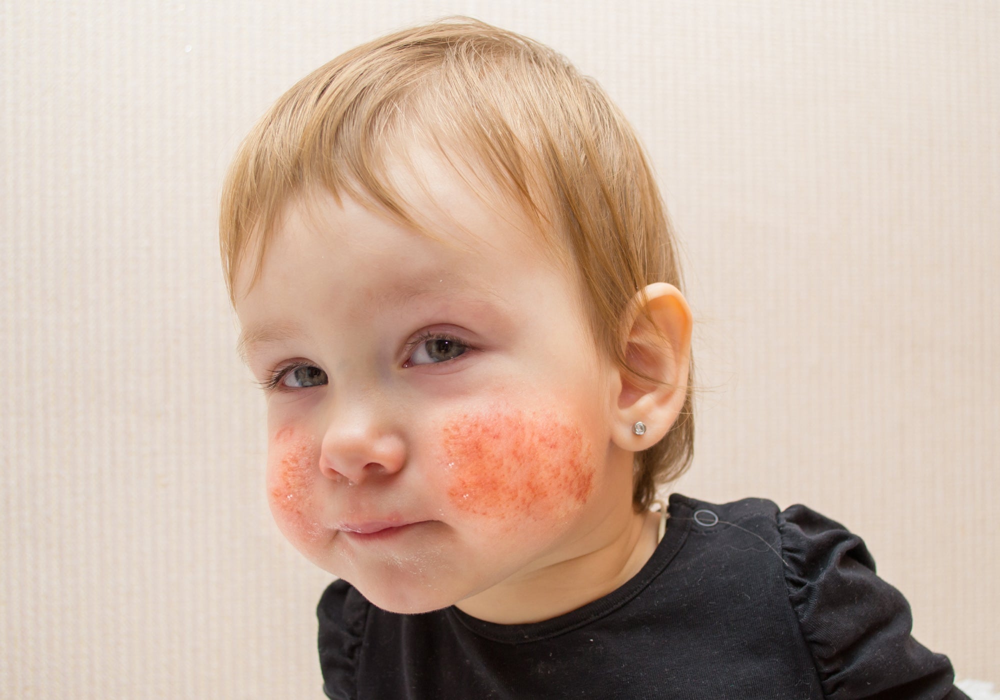 Best Natural Non-Sting Cream For Perioral Dermatitis In Toddlers