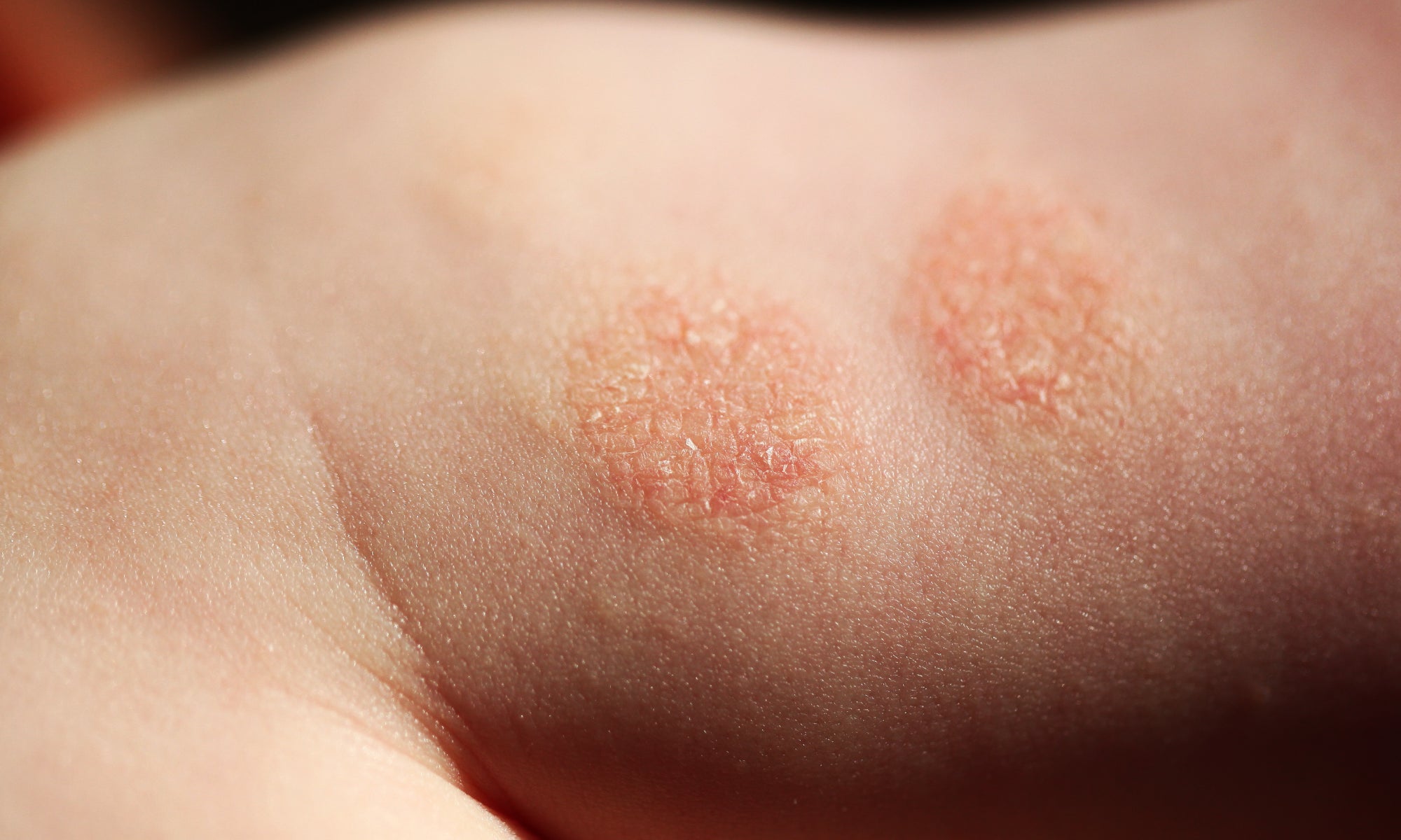 An example of Discoid Dermatitis on skin