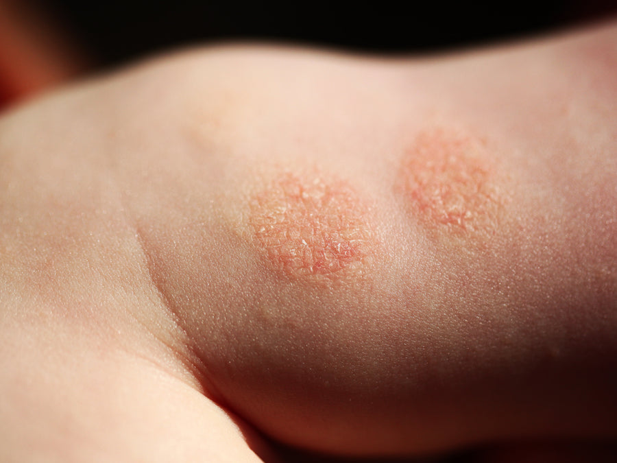 An example of Discoid Dermatitis on skin