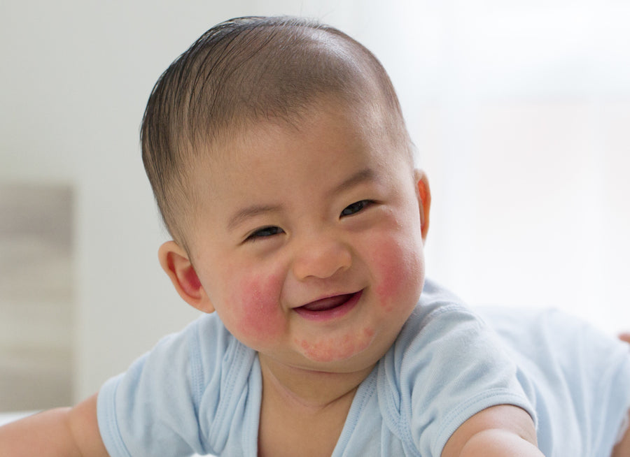 baby with eczema on cheeks