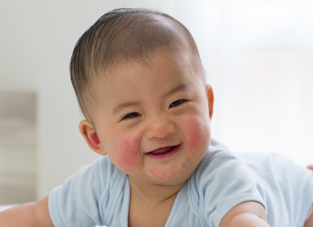 baby with eczema on cheeks