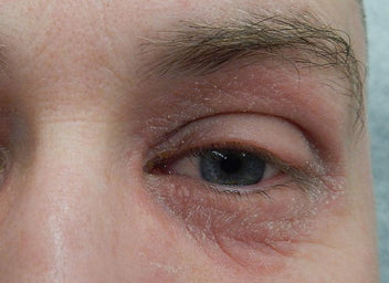 What Does Periocular Dermatitis Look Like? – Balmonds