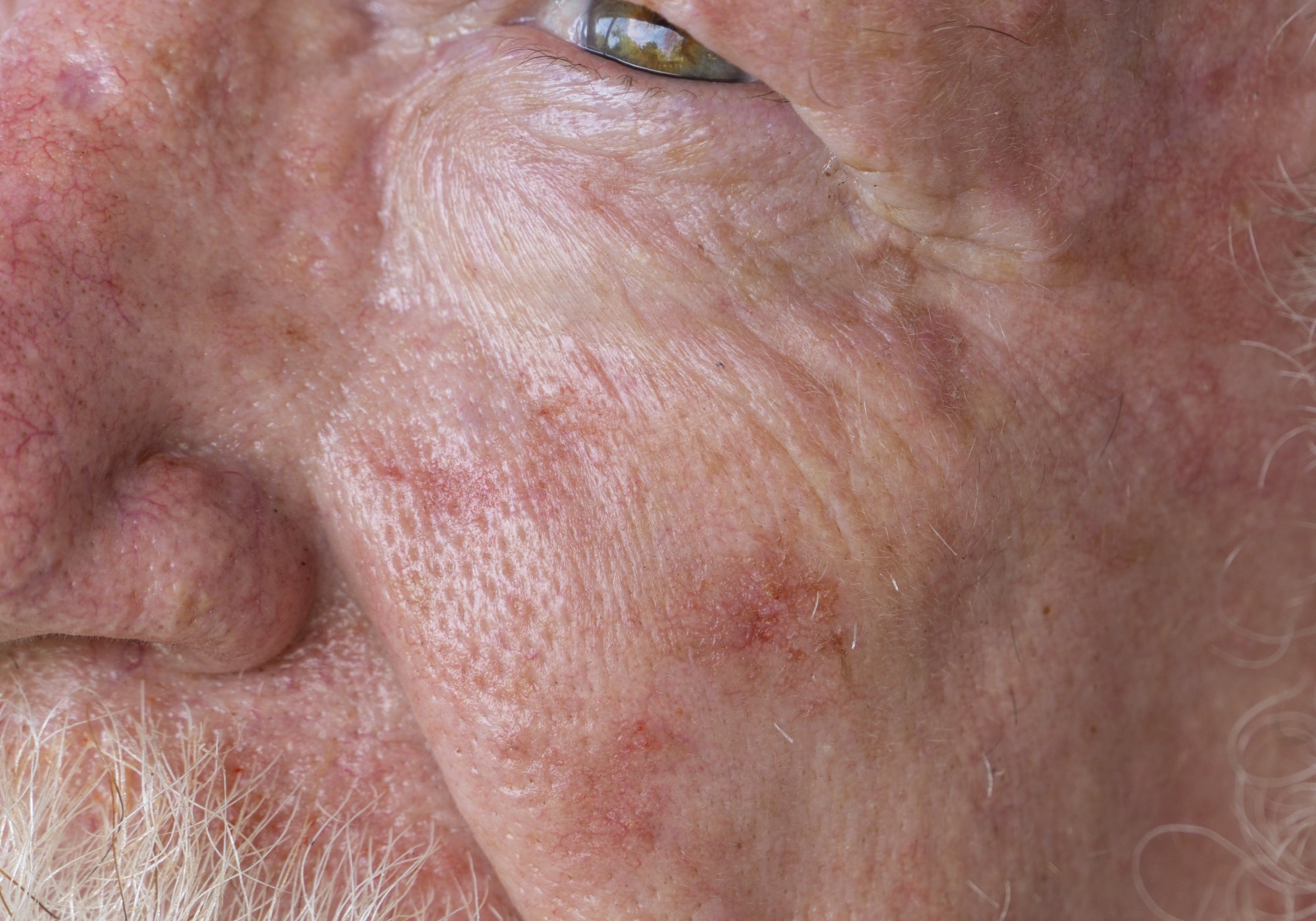 An example of Actinic Keratosis on the face