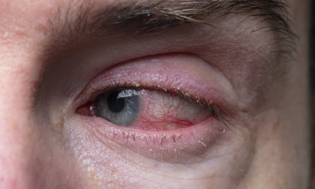 Example of Blepharitis