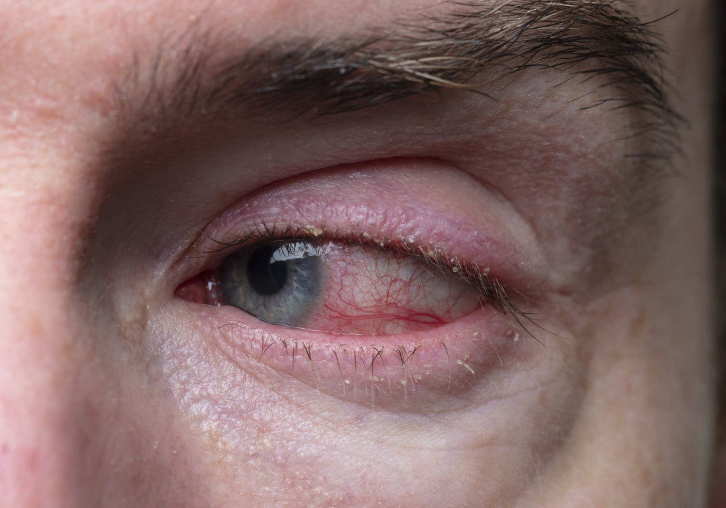 Example of Blepharitis