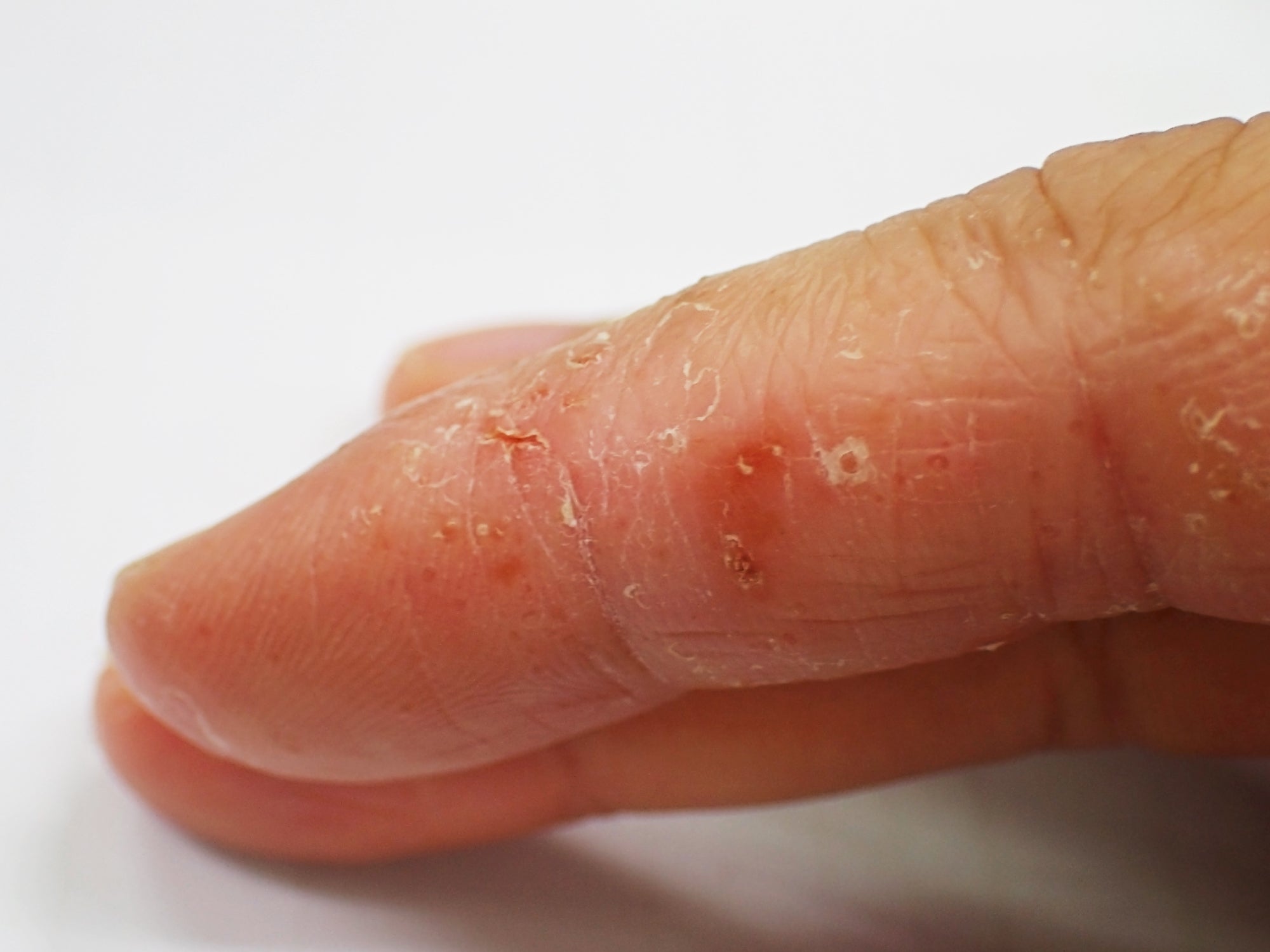 An example of Dyshidrotic Eczema on an index finger