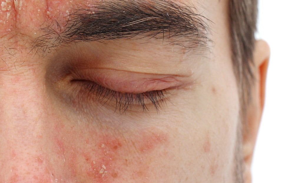 Man with periocular dermatitis