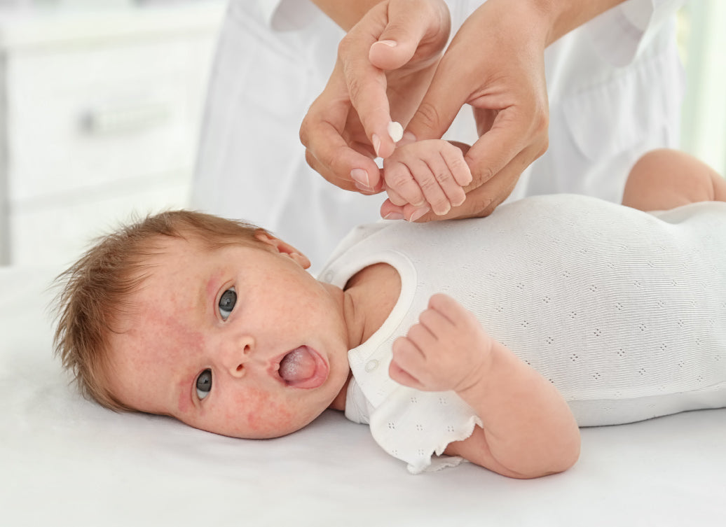 Baby with eczema laying on its back