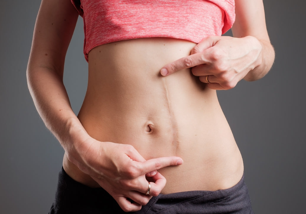 A scar on an abdomen 