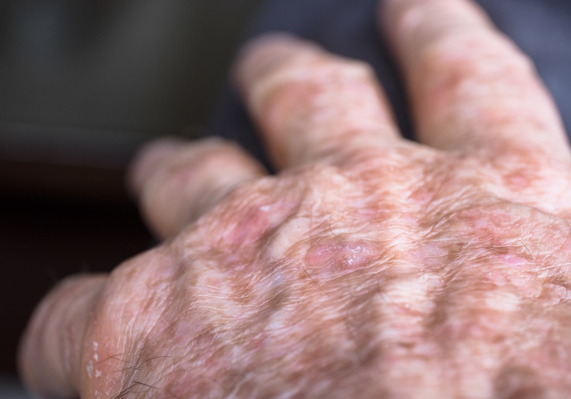 Actinic Keratosis on the hands