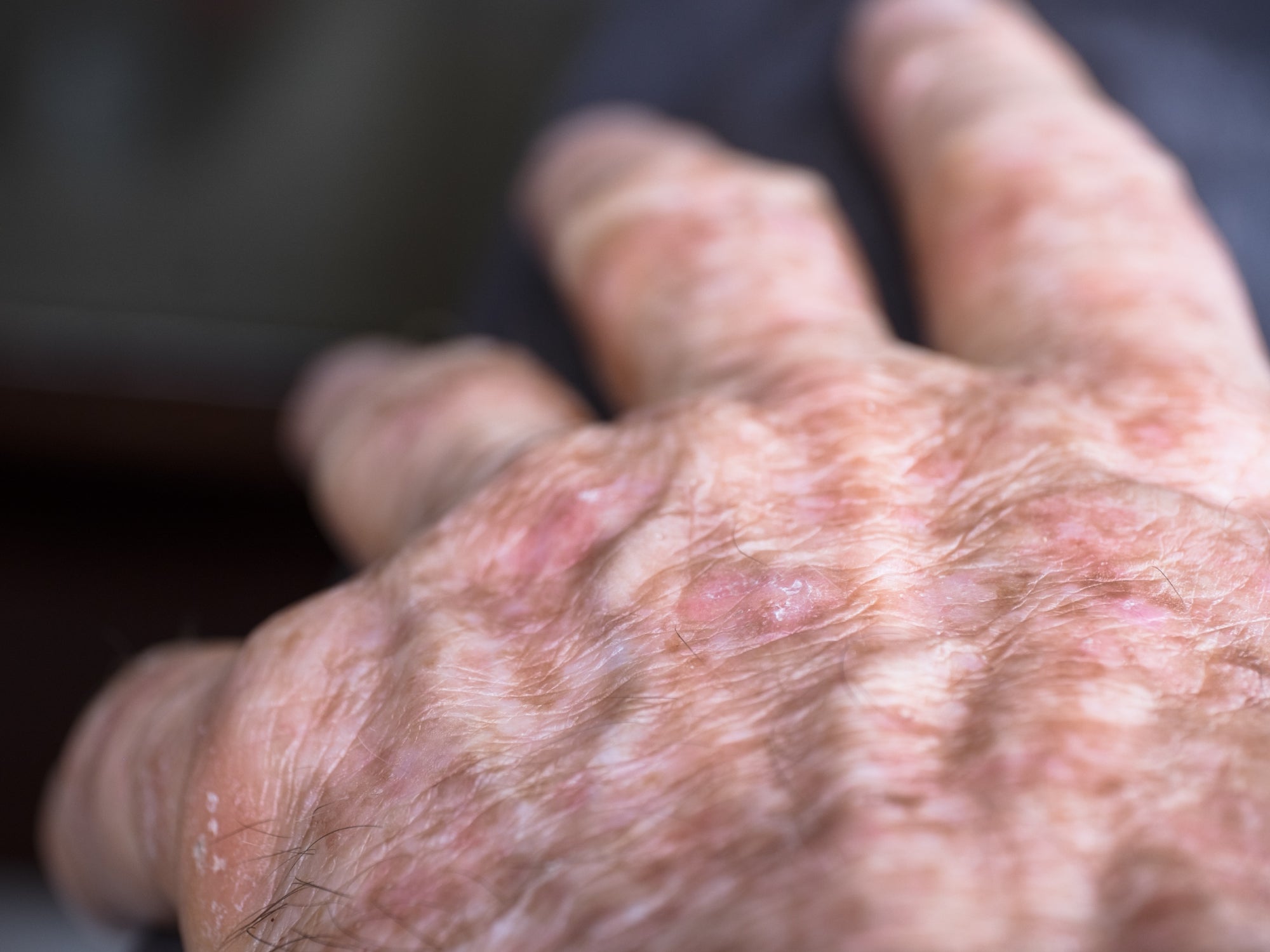 Actinic Keratosis on the hands