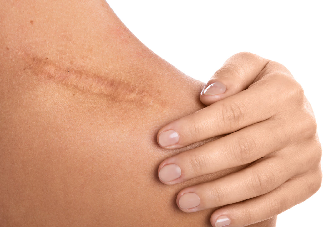 A scar on a shoulder