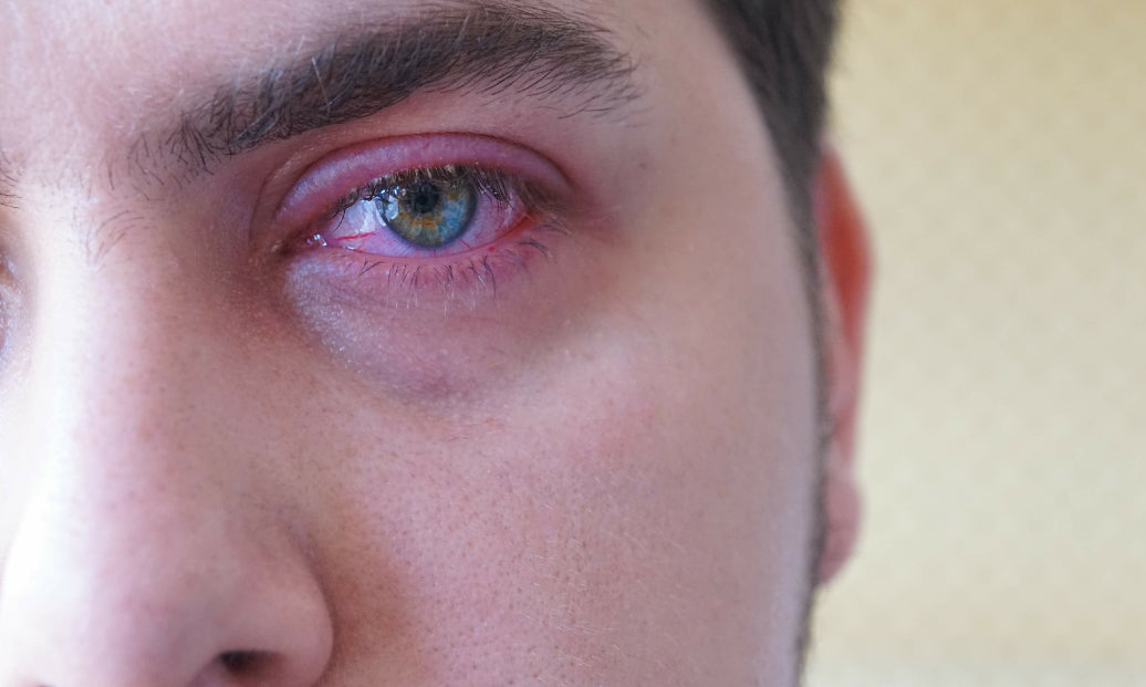 red Blepharitis around the eye