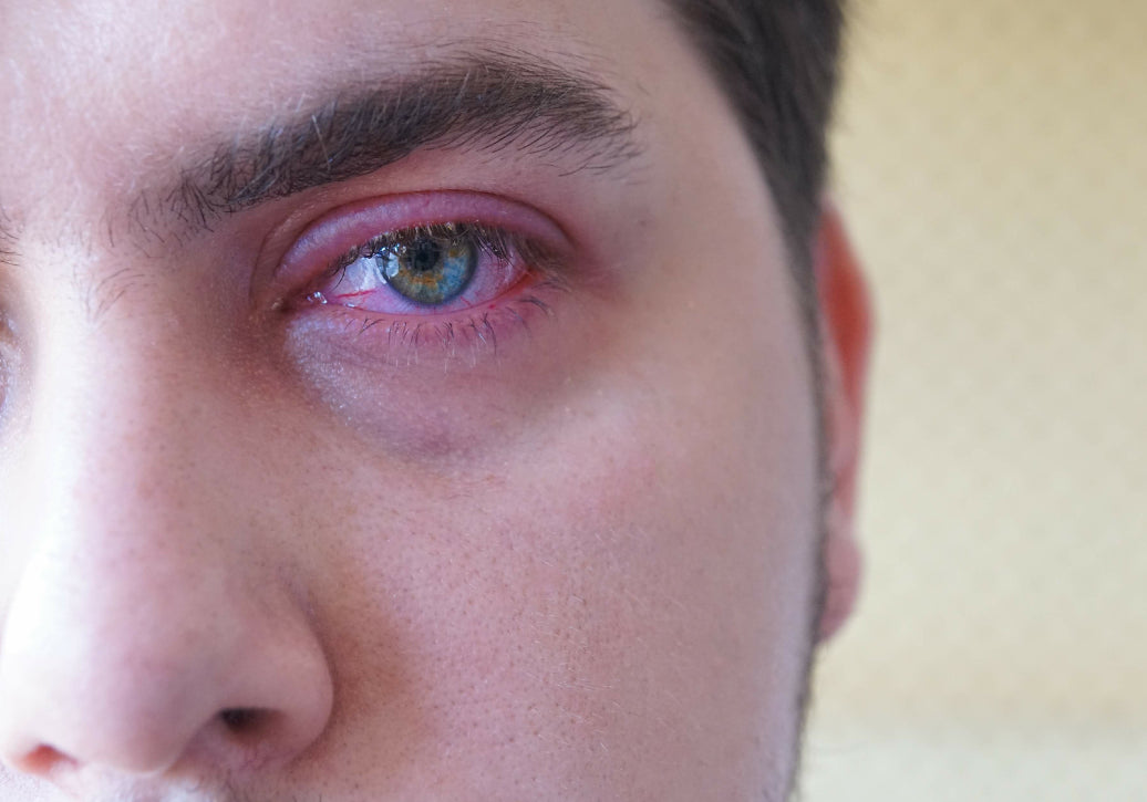 red Blepharitis around the eye