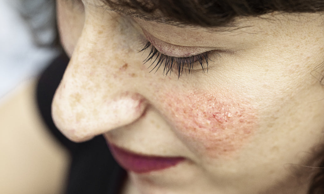 What Is The Main Cause Of Rosacea?