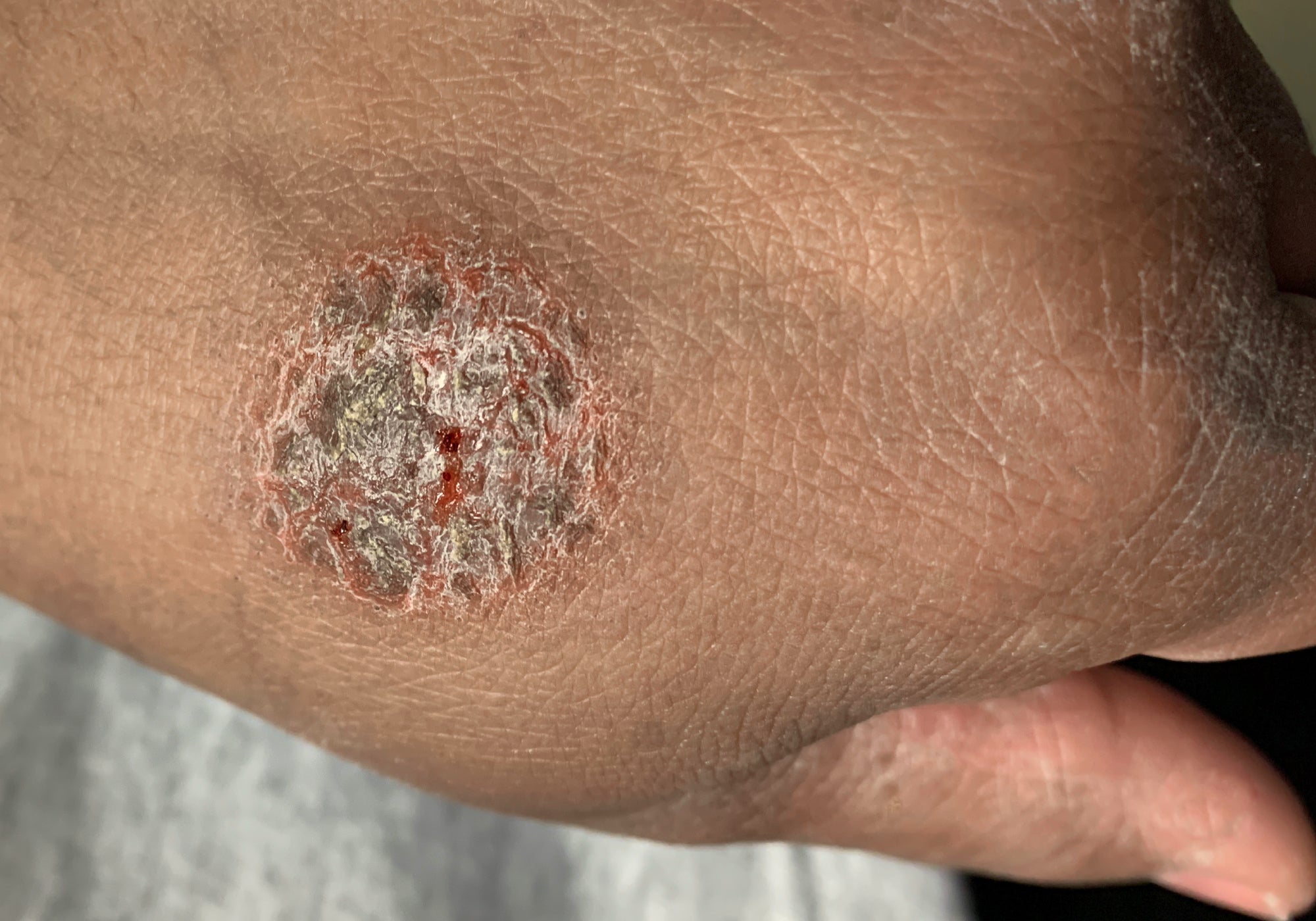 An example of Nummular Eczema on the back of the hand