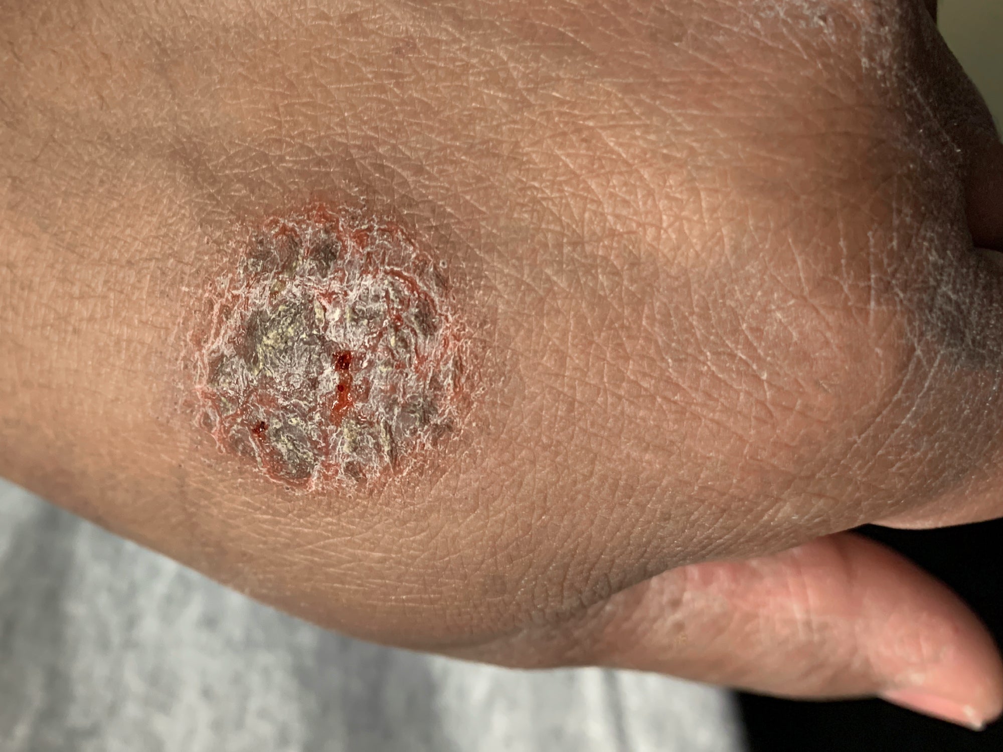 Coin Rash What Triggers Nummular Eczema? – Balmonds