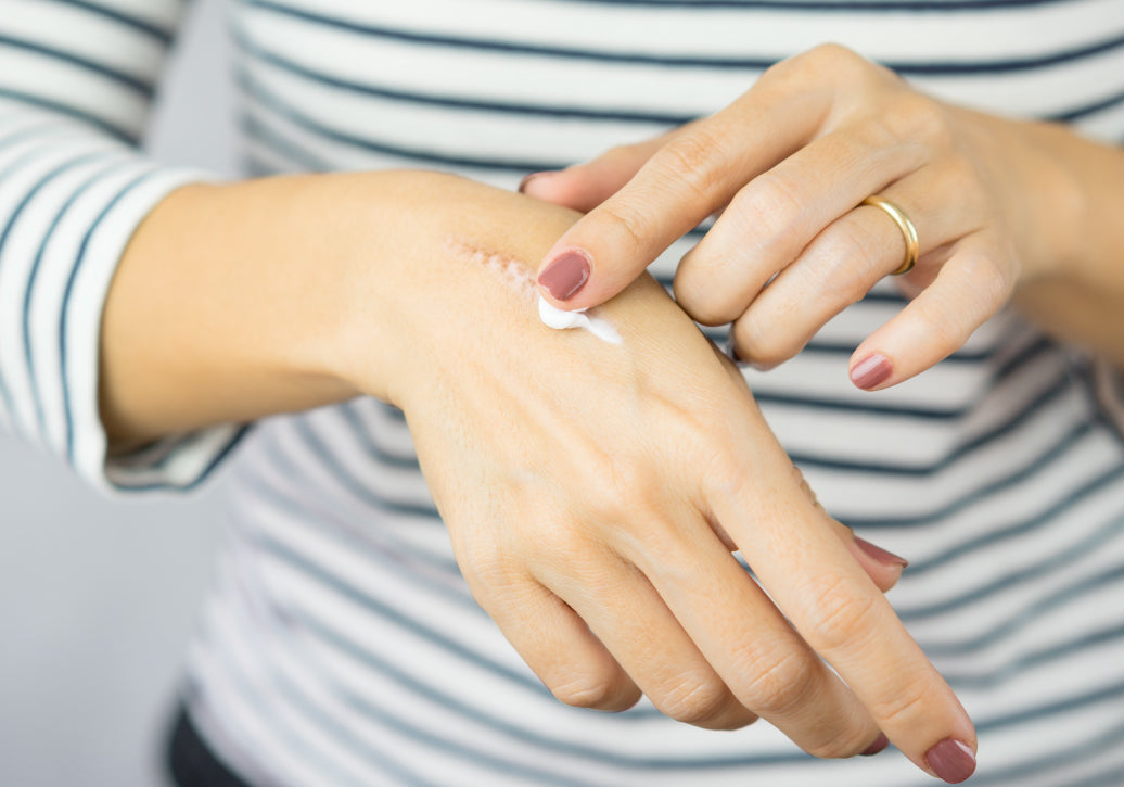 Applying cream to a scar on the back of a hand
