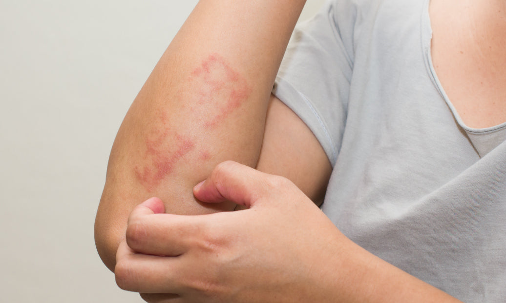 What’s Usually The First Sign Of Dermatitis?