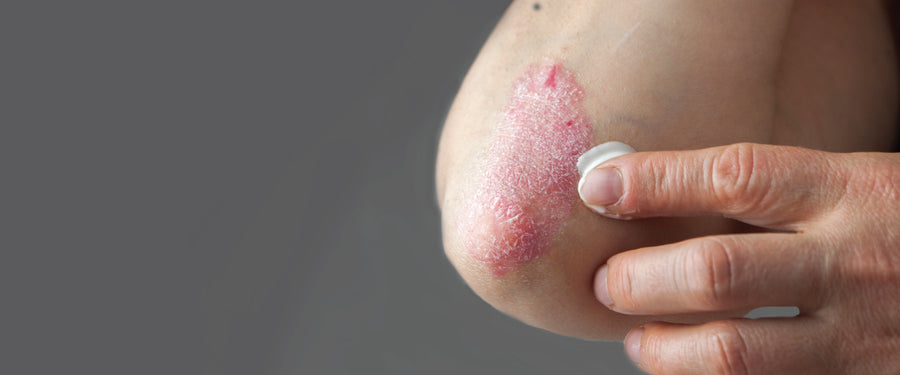 What's The Best Cream For Psoriasis?