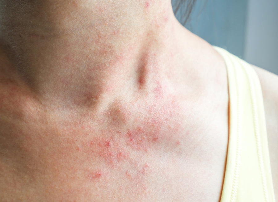 eczema around the neck