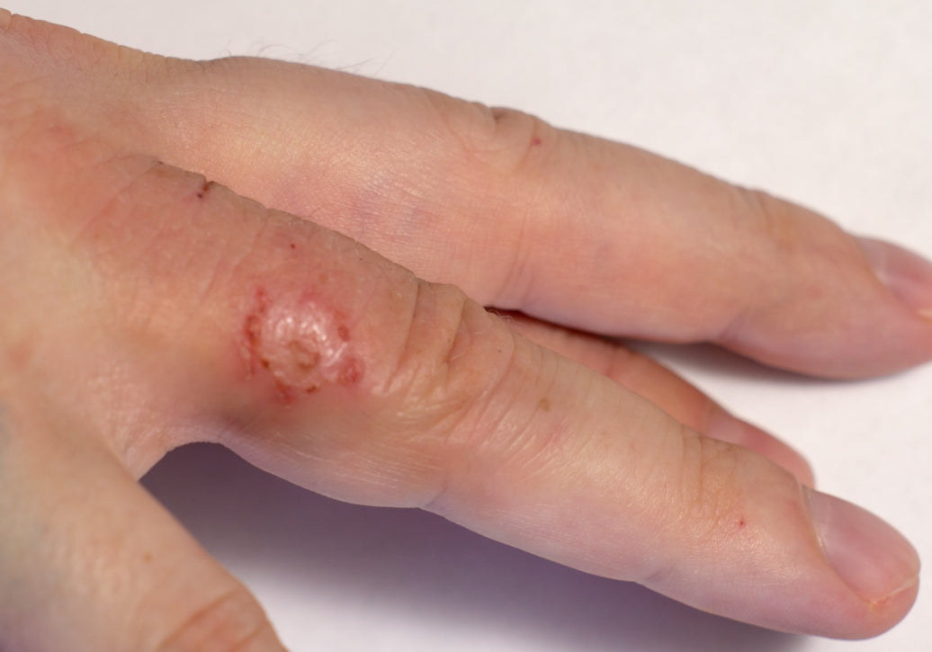 Nummular Eczema on the inside of an index finger
