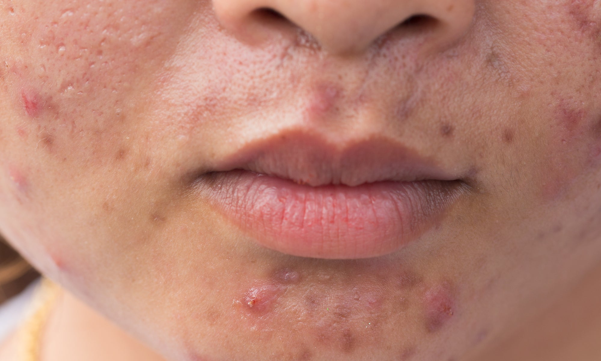 What Does Acne Rosacea Look Like?