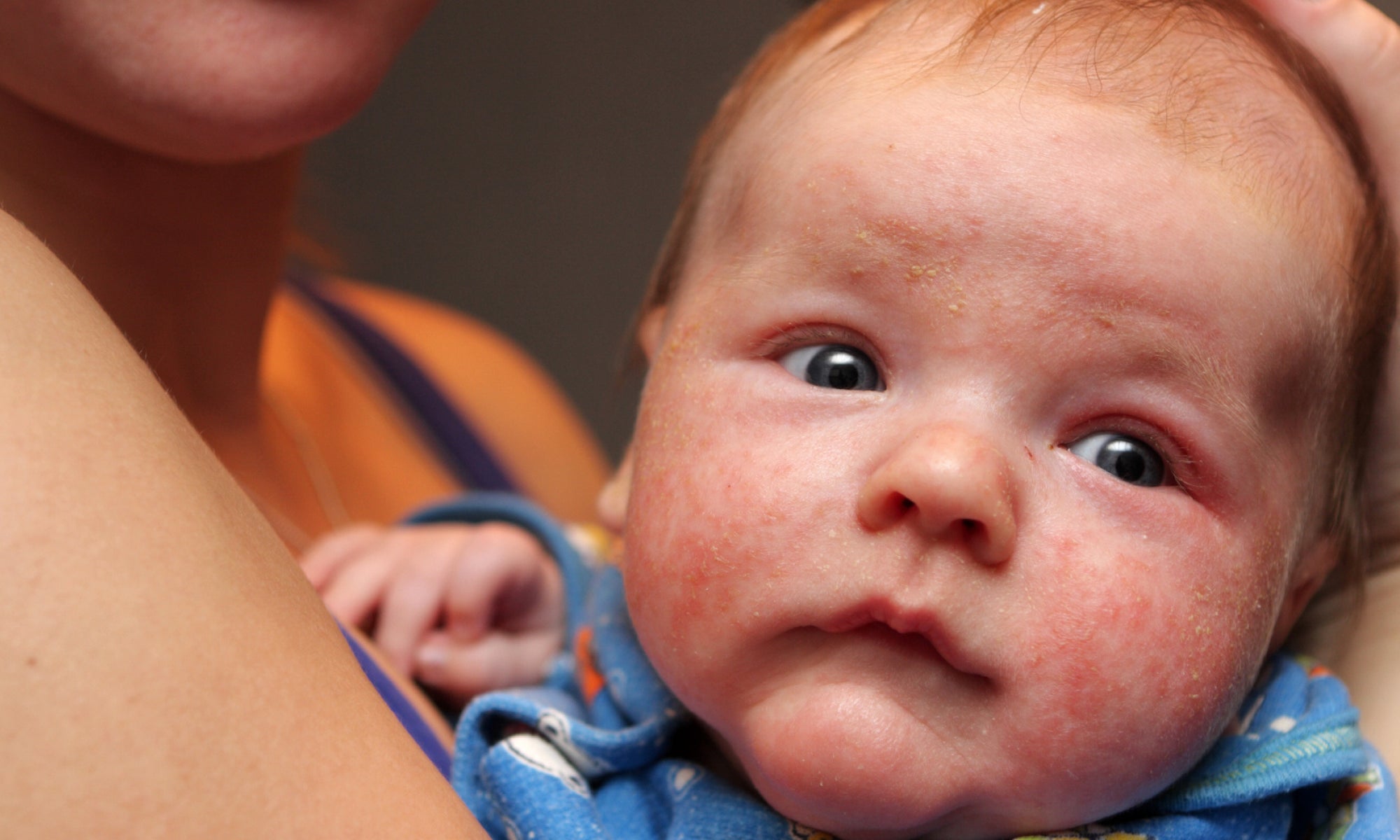 How To Soothe Topical Steroid Withdrawal In Babies