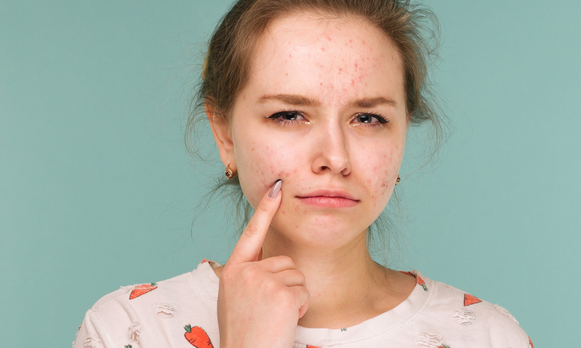 Best Natural Treatment For Acne And Face Eczema