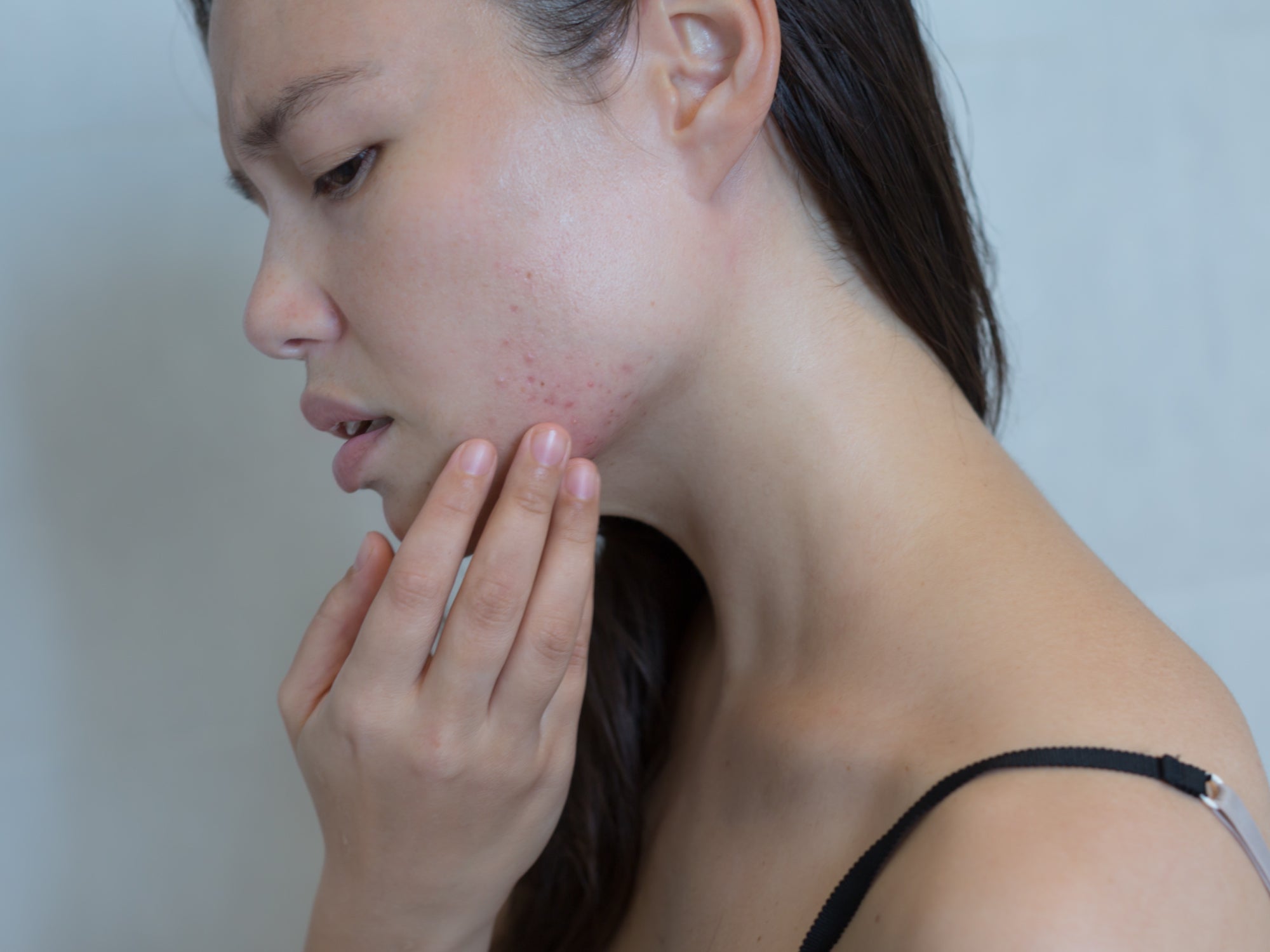 How To Get Rid Of Waxing Rash On Your Face During Lockdown Balmonds