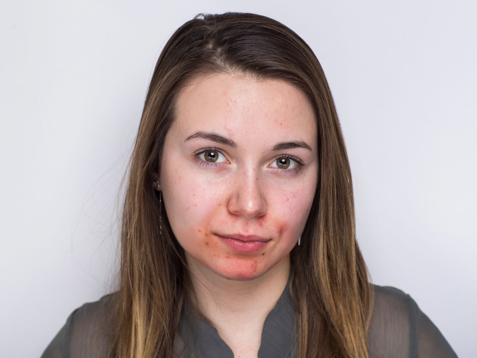 What is Acne Rosacea?