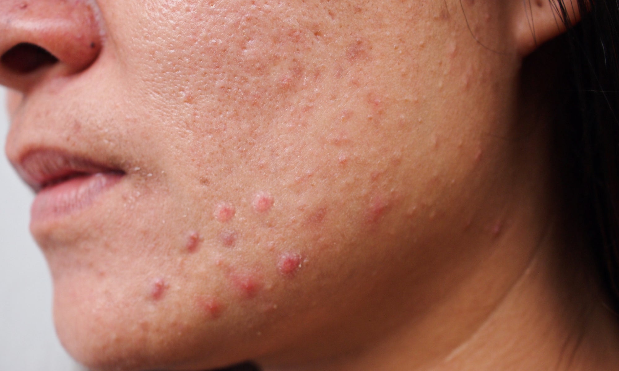 Is It Possible To Get Rid Of Acne Rosacea?