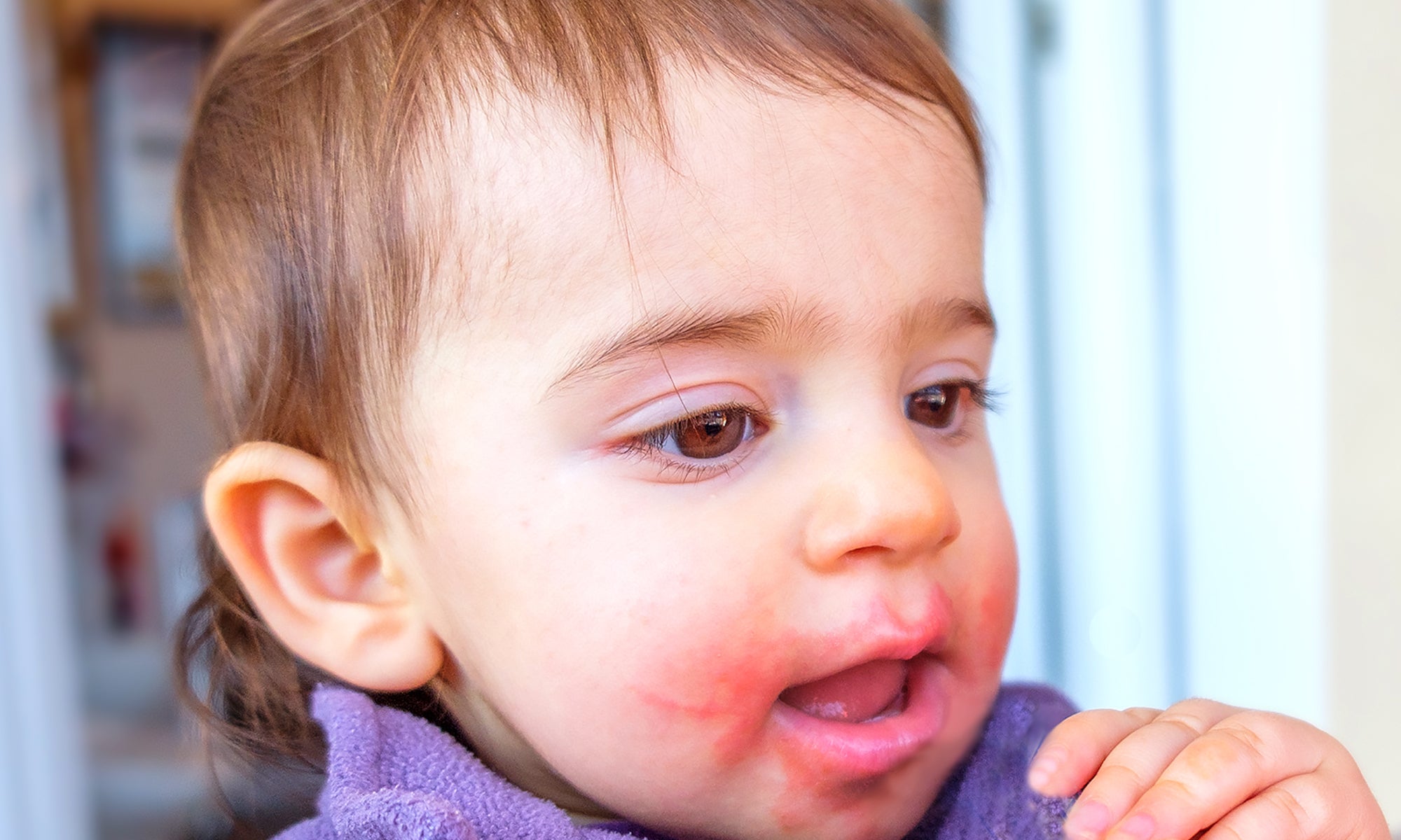 Can Perioral Dermatitis Get Better On Its Own?