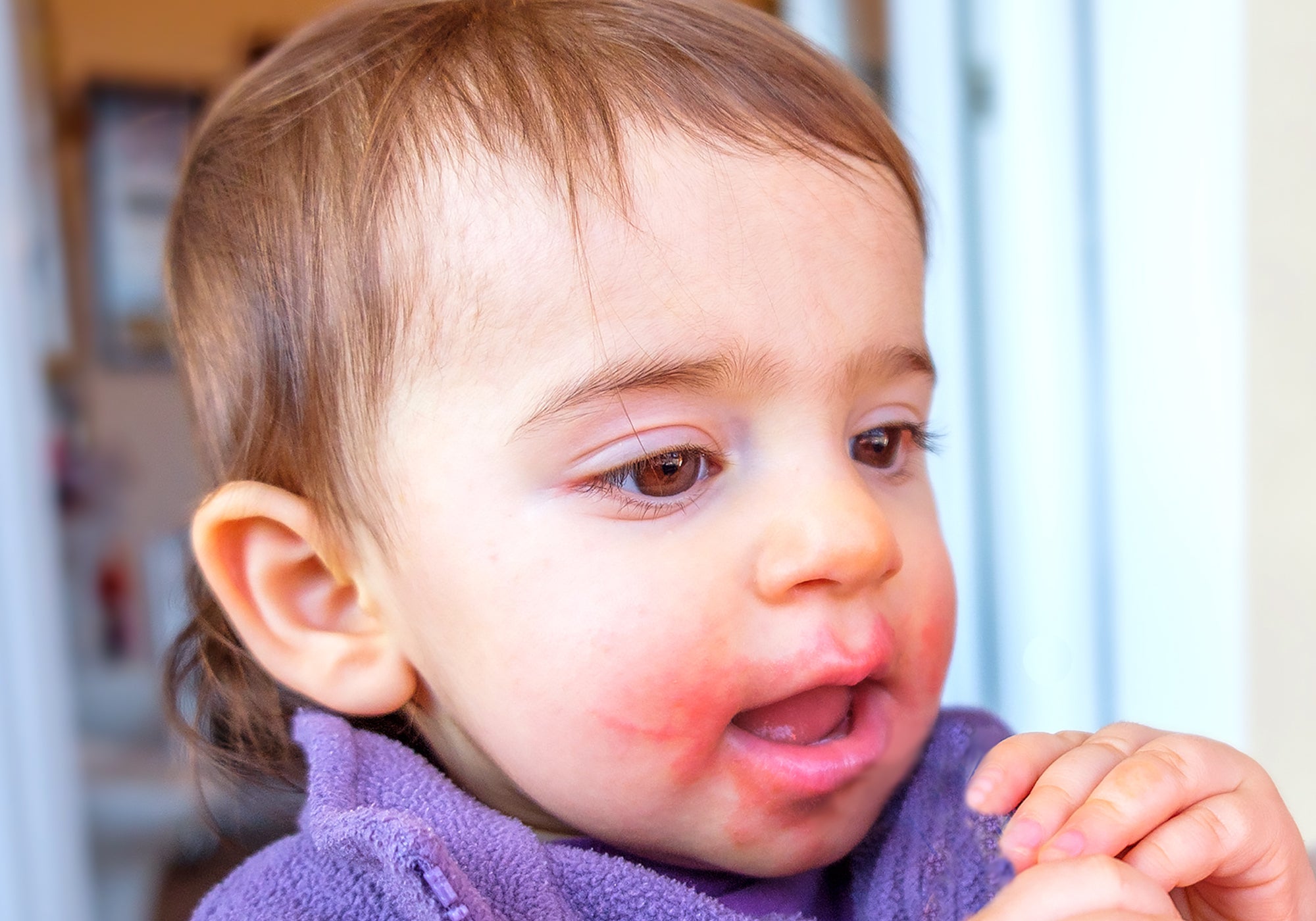 Can Perioral Dermatitis Get Better On Its Own?